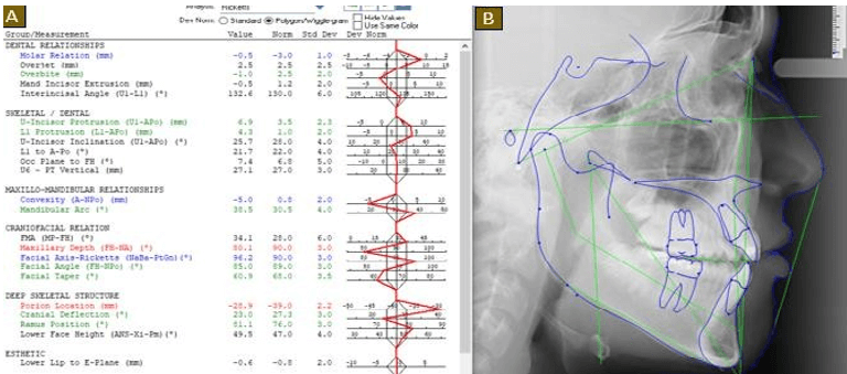 Figura1.A: Resultado del trazado cefalómetro; B: Trazado cefalometrico de Ricketts.