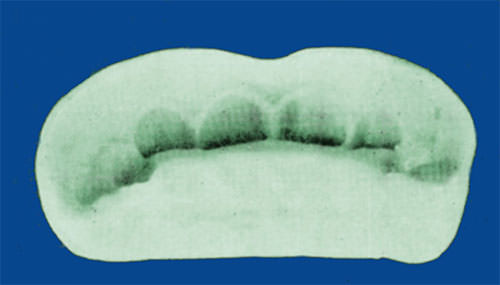 Figura 2 Placa vestibular de Hotz o pantalla vestíbular en acrílico