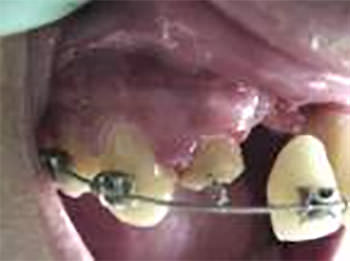 Caso clínico de intrusión con fractura en diente tratado endodónticamente, el diente contiguo se perdió por avulsión, el diente intruído, fue traccionado ortodóncicamente, con arcos de níquel titanio