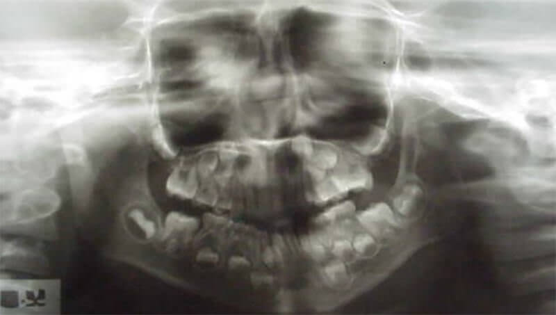 Radiografía panorámica de la paciente y detalle de la zona condilar donde se aprecia la ausencia del mismo.