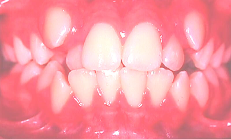Apiñamiento dentario en zona anterior acompañado de Caninos ectópicos y mordida cruzada del 12 y 22.