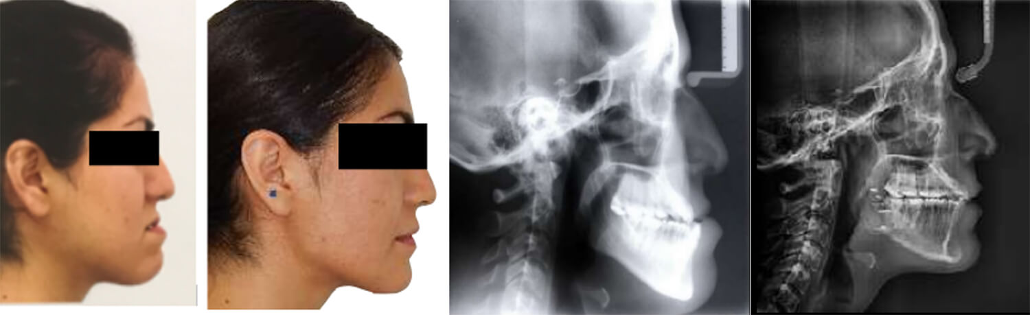 Fig. 11 Extraoral de perfil, radiográfica lateral de cráneo, comparación inicio final. 