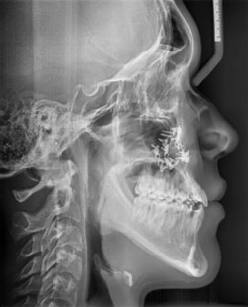 Fig. 19 Radiografía lateral de cráneo final