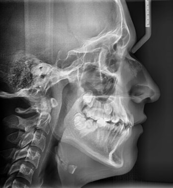 Fig. 3 Radiografía lateral de cráneo de inicio