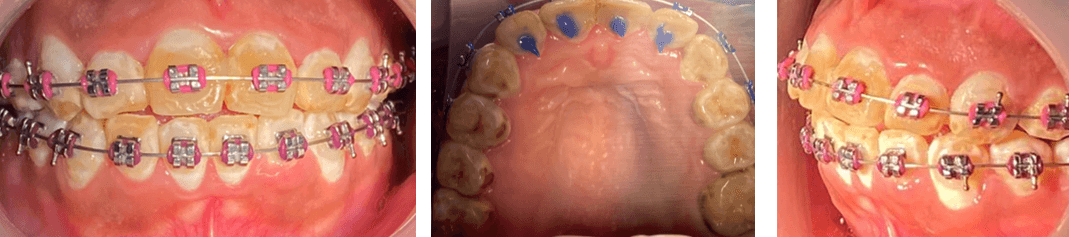 IMAGEN #9 Fotografias intraorales se colocan spikes palatinos para evitar habito de lengua y evitar alguna preyeccion dental 