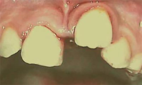 Lujación lateral extrusiva