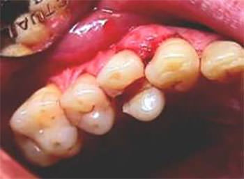 Fractura complicada de corona