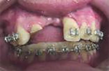 Caso clínico de intrusión con fractura en diente tratado endodónticamente, el diente contiguo se perdió por avulsión, el diente intruído, fue traccionado ortodóncicamente, con arcos de níquel titanio