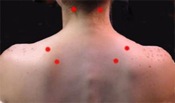 Figuras 1 Puntos gatillo que pueden ser fácilmente detectados por el odontólogo en cuello y espalda