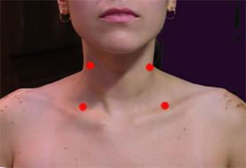 Figuras 2 Puntos gatillo que pueden ser fácilmente detectados por el odontólogo en cuello y espalda