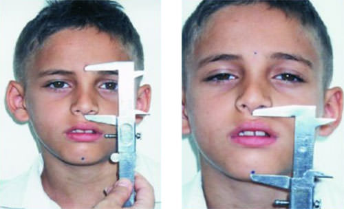 Altura facial inferior A: Área superior o nasoorbitaria B: Área inferior bucal