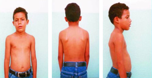 Examen Esquelético A: Pectus escavatus - B: Escápula aladas<br>C: Cifosis Lordosis