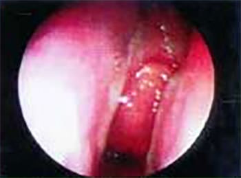 Hipertrofia de adenoides