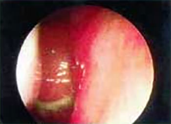 Hipertrofia de cornetes