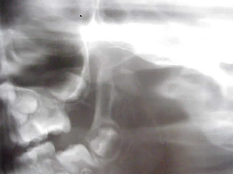 Radiografía panorámica de la paciente y detalle de la zona condilar donde se aprecia la ausencia del mismo.