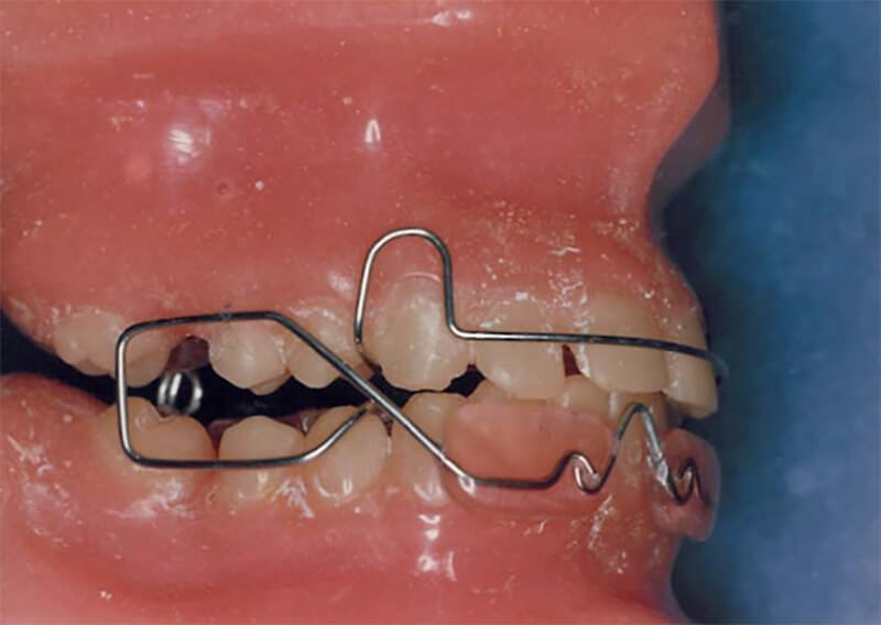 Posicionador mandibular activo Quirós - Crespo.