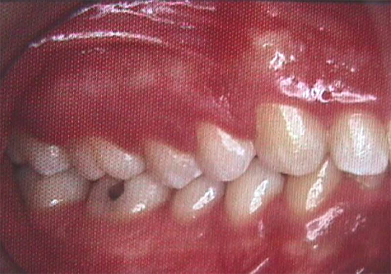 Foto intraoral derecha de paciente con relación molar De Clase I. Postgrado de Ortodoncia, Facultad de Odontología, U.C.V.