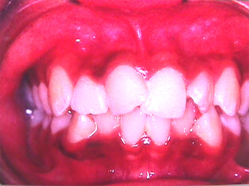 Apiñamiento dentario en zona anterior acompañado de rotación del 11, 22, 33 y 43; linguoversión del 32 y 42 y vestibuloversión del 11.