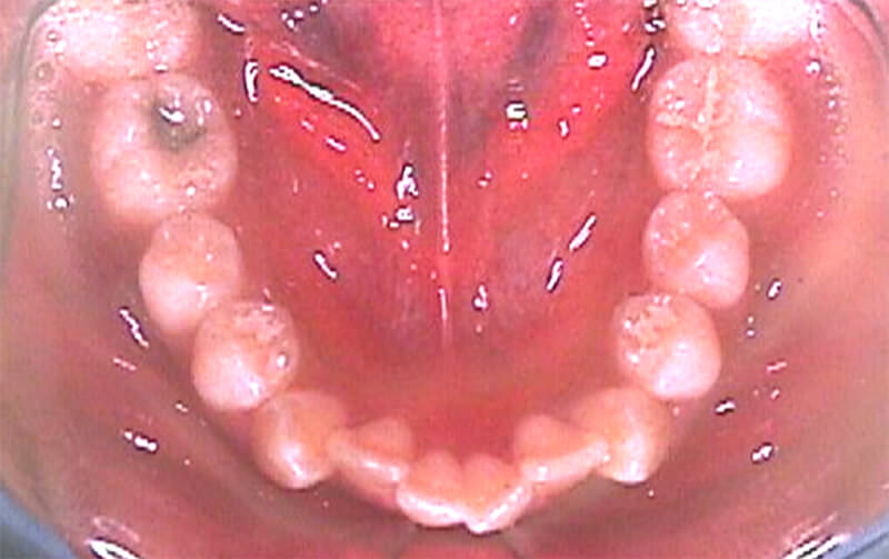 Apiñamiento dentario en zona anterior acompañado de rotación del 35 y 45.