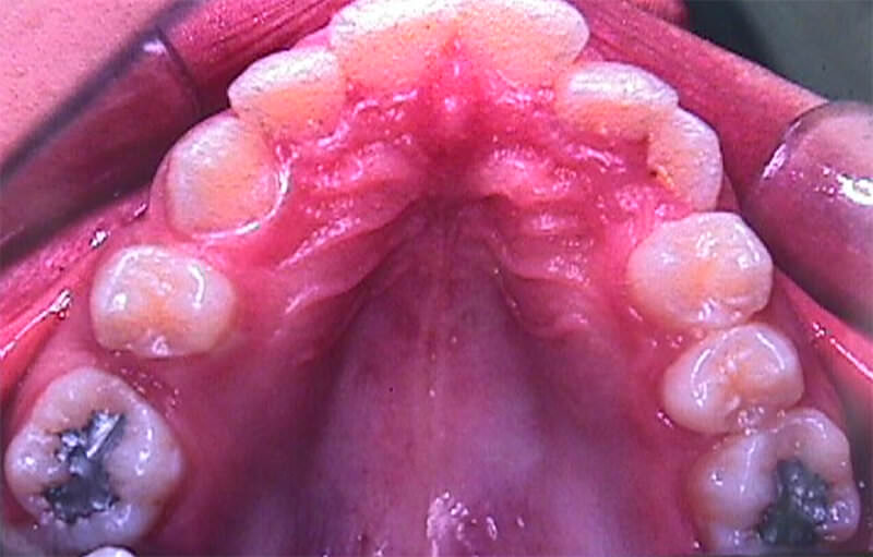 Apiñamiento dentario en zona anterior acompañado de Pérdida del 15 con cierre de espacio y rotación del 14 y 16.
