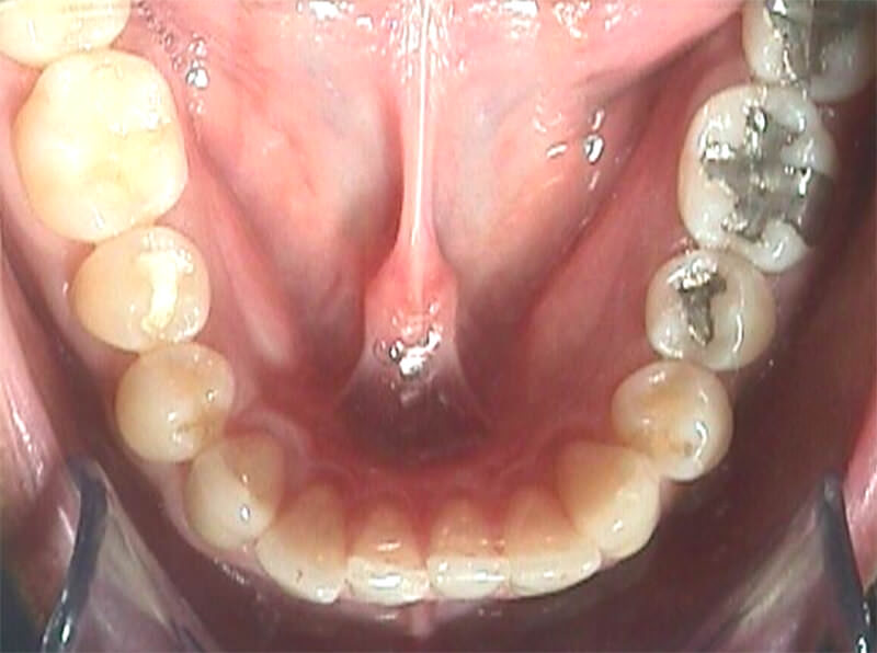 Apiñamiento dentario en zona anterior acompañado de rotación del 34 y 45; y vestivuloversión del 42.