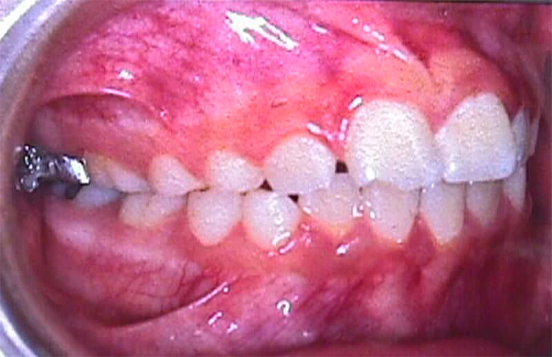 Incisivos superiores vestibularizados con diastemas entre 11-12 y 21-22. Relación canina y molar de Clase I.