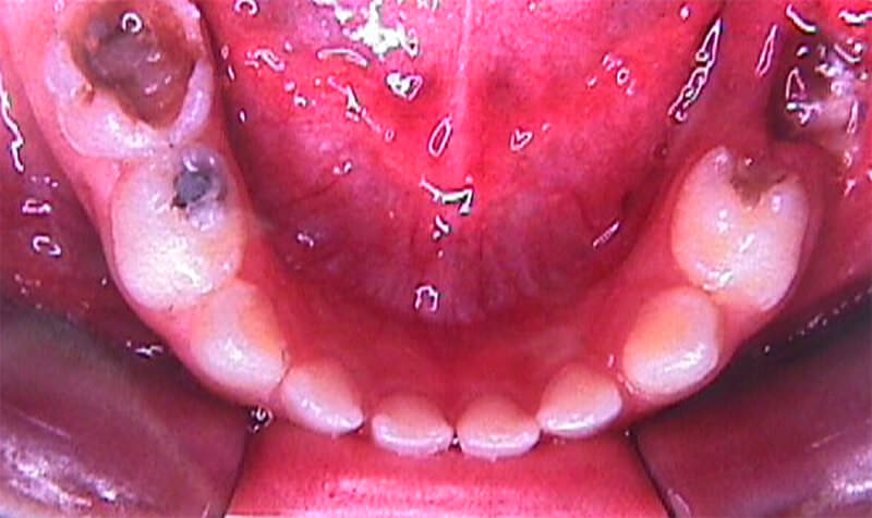 Caries en caras oclusales e interproximales de Molares temporales.