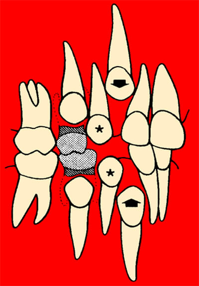 2ª. Fase de tratamiento de exodoncias seriadas: Exodoncia de primeros premolares.