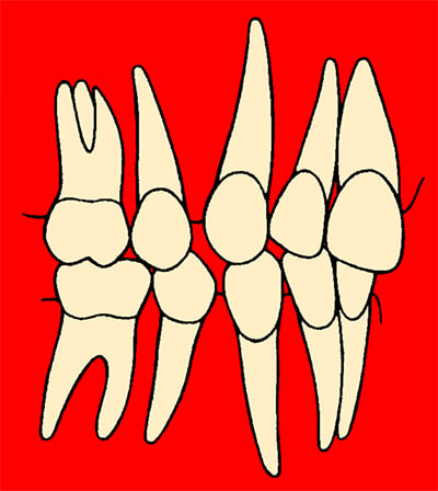 3ª. Fase de tratamiento de exodoncias seriadas: Tratamiento activo.