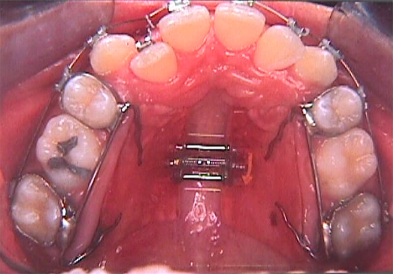 Tratamiento ortodóncico combinado con expansión fija.