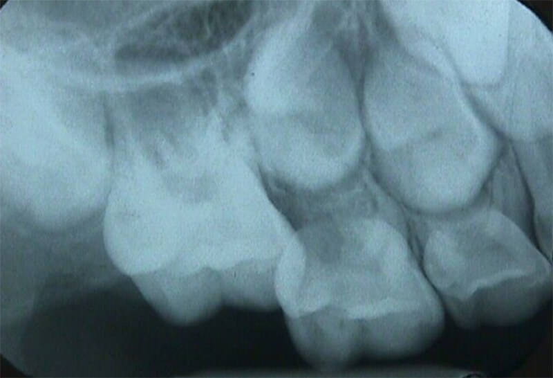 Radiografía donde se aprecia la reabsorción de la raíz distal del 55 por erupción ectópica del 16. Postgrado de Ortodoncia, Facultad de Odontología, U.C.V.