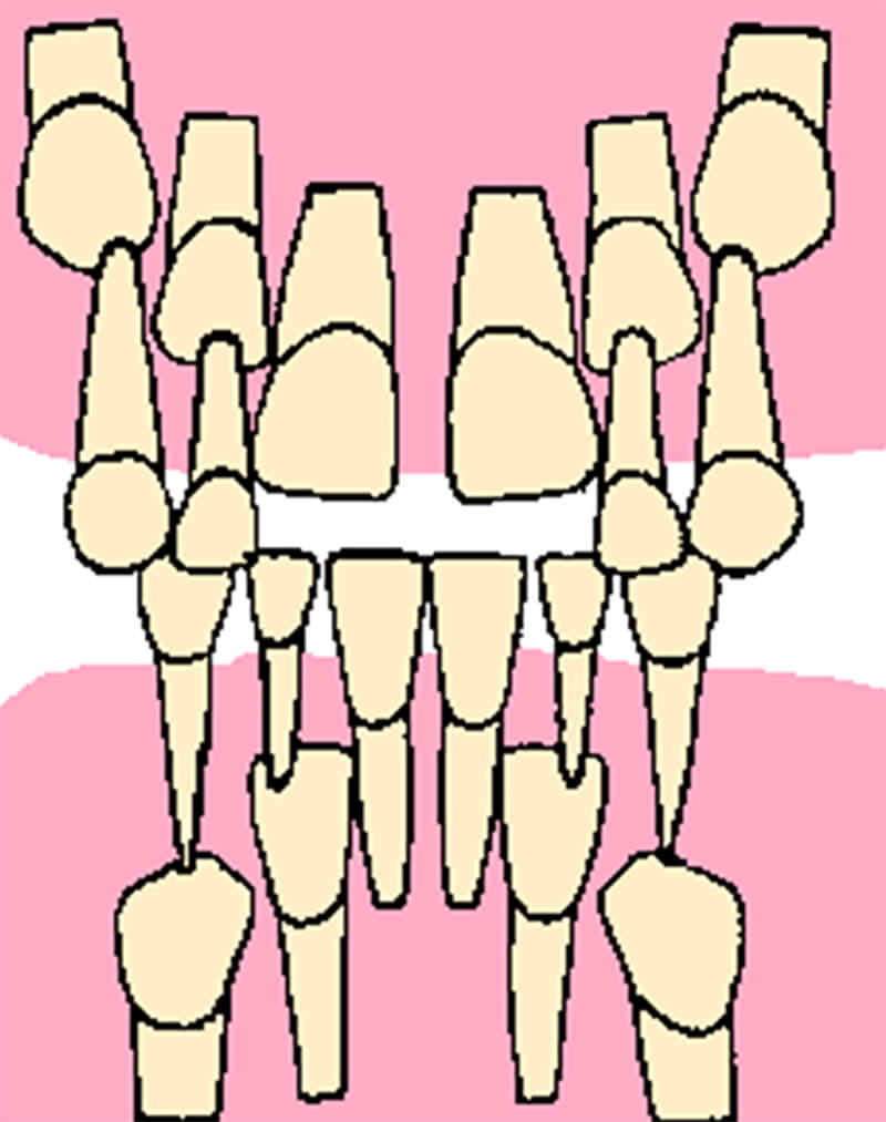 Dibujo esquemático de las características radiográficas observadas por Van der Linden con referencia al incisivo lateral temporal superior de un paciente con patrón de erupción normal.