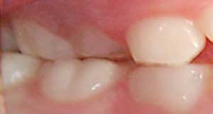 Clasificación de mordida cruzada dental posterior / A - Posterior parcial