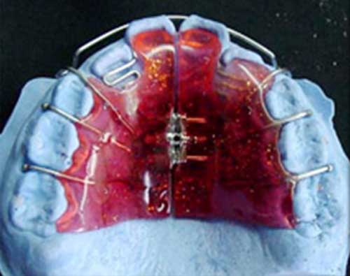 Análisis transversal de los modelos: ancho Intermolar e Intercanino en pacientes de 5 a 10 de edad Diplomado de Ortodoncia Interceptiva UGMA 2007