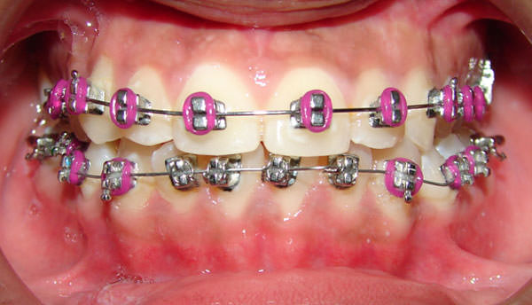 Tipos de arcos para brackets - SOFDental