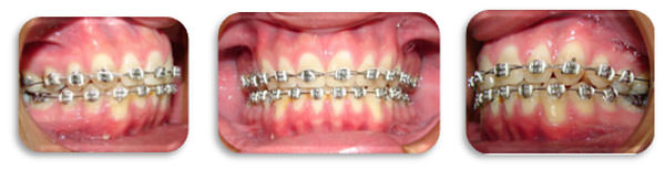 Tipos de arcos para brackets - SOFDental