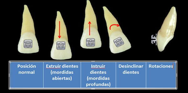 Tipos de arcos para brackets - SOFDental