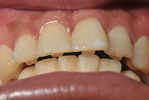 bite blocks composite palatal