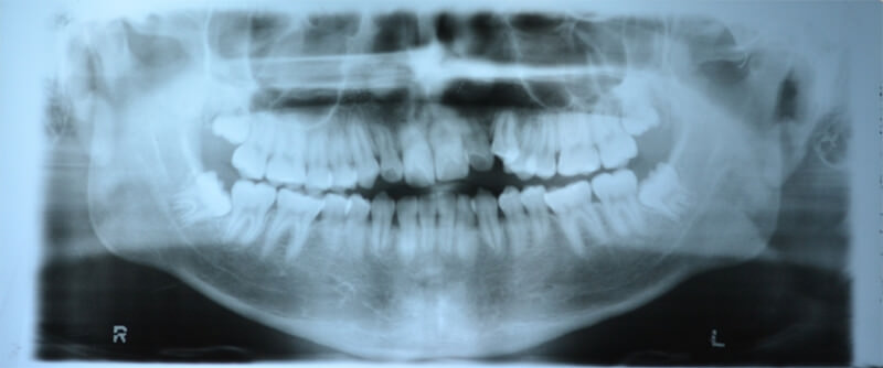Figura 1. Radiografía panorámica de paciente antes de su inicio de tratamiento ortodoncico y aquí claramente podemos observar  raíces cortas de algunos dientes.