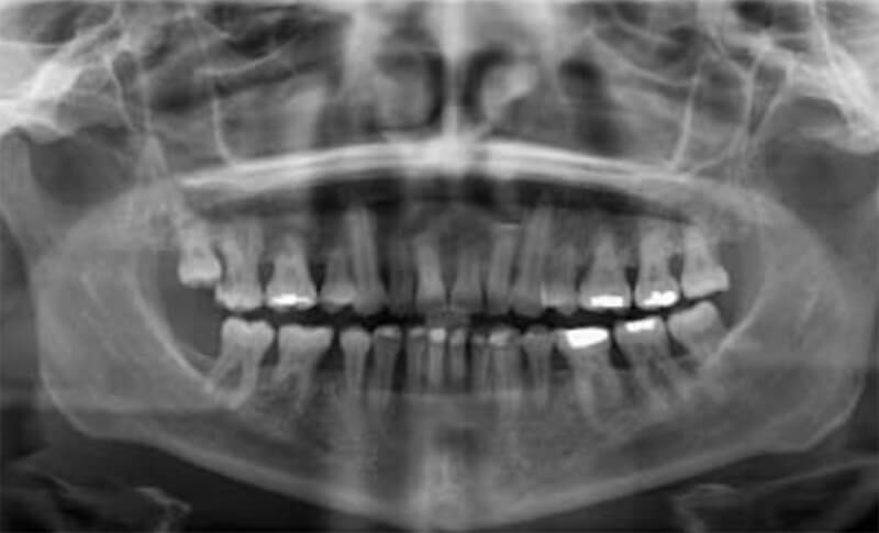 Figura 2. Reabsorción radicular por tratamiento de ortodoncia