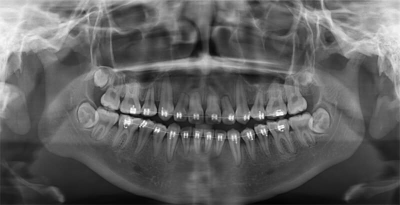 Figura 5. Radiografía panorámica de paciente con retratamiento de ortodoncia donde se observa raíces con reabsorción de algunos órganos dentales