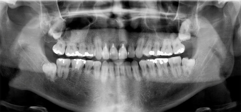 Figura 7. Tratamiento endodóntico en dientes con resorción radicular severa