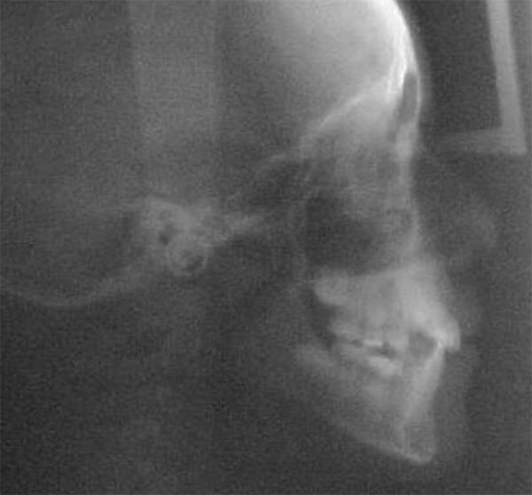 Figura 11. Radiografía lateral de cráneo de progreso