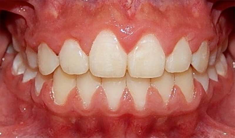 Figura 16. Fotografía intraoral final de frente de sonrisa.