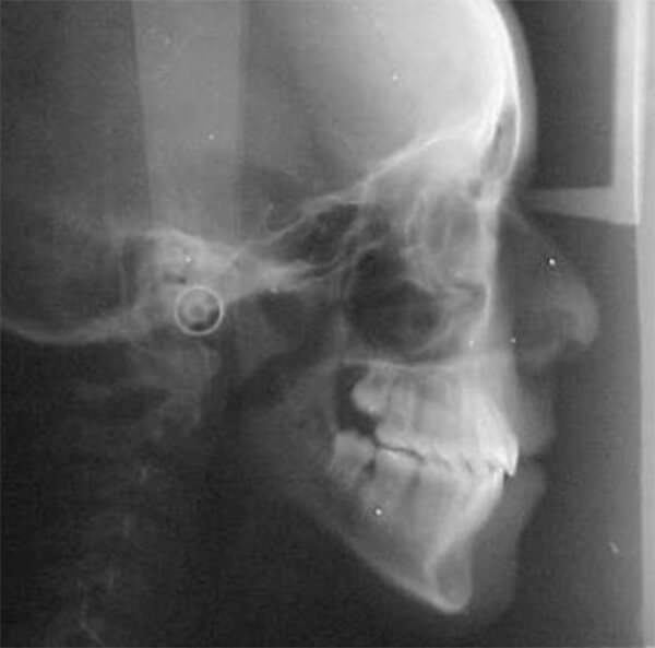 Figura 19. Radiografía lateral de cráneo final