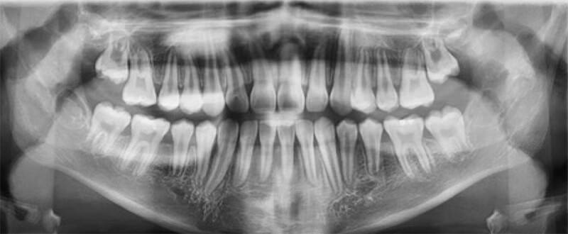 Figura 20. Radiografía Panorámica