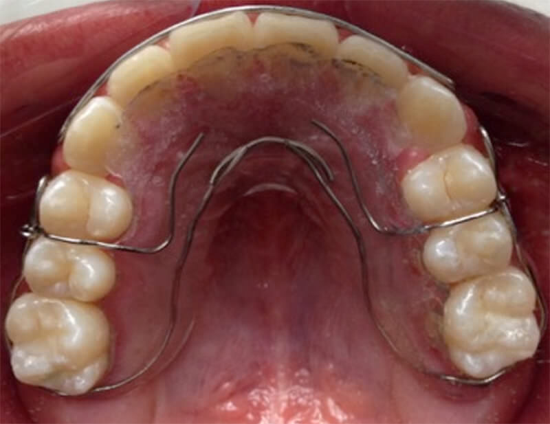 Figura 22. Intraoral del retenedor superior