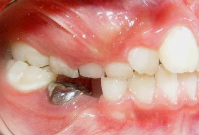 Figura 4. Intraoral derecha