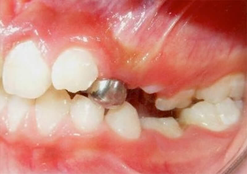 Figura 5. Intraoral izquierda