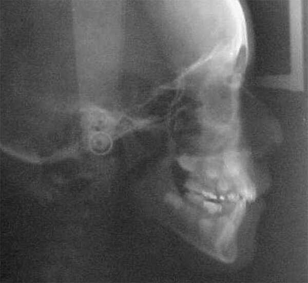 Figura 6. Radiografía lateral de cráneo